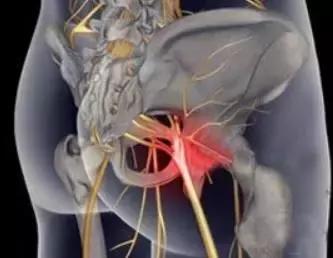 坐骨神经痛只需一招根除,腰间盘突出坐骨神经痛怎么治疗好