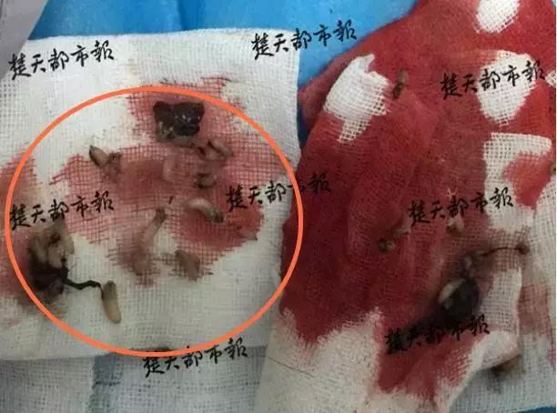 男子后脑勺长了几个疙瘩,男子颅内长活虫