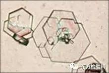 尿中结晶达到多少就是结石了,尿结晶数高是病吗