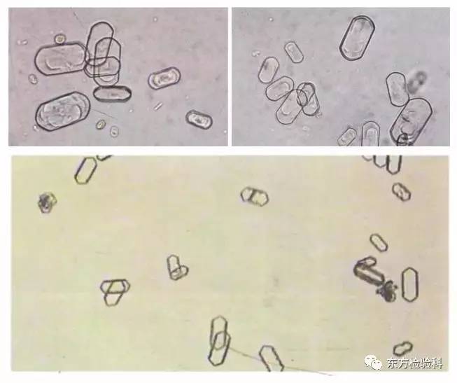 尿中结晶达到多少就是结石了,尿结晶数高是病吗