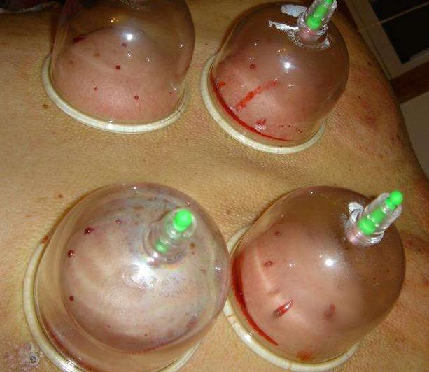 艾灸后牙疼上火怎么办,上火艾灸什么部位降火