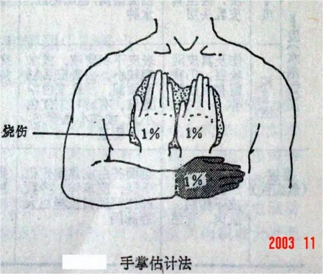 烫伤后抹红霉素管用还是牙膏管用,烫伤涂酱油为什么可以缓解疼痛