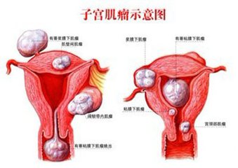 老年子宫肌瘤有哪些症状,子宫肌瘤10厘米没有任何不适症状