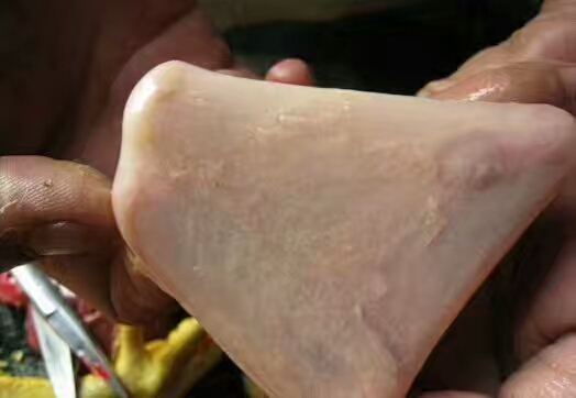 鸡念珠菌的症状及表现,白色念珠菌是什么原因形成的