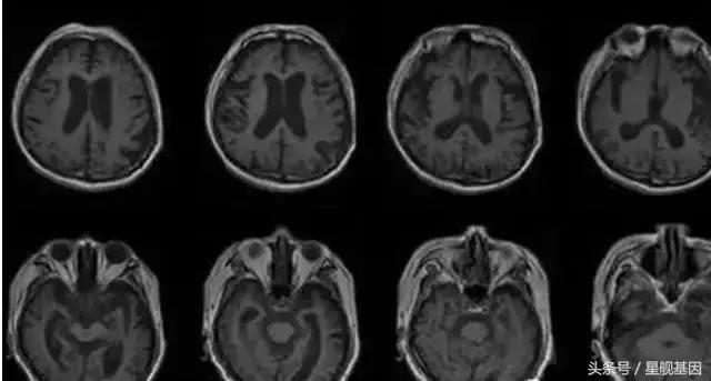 我的前半生薛甄珠有没有活过来,我的前半生薛甄珠病了