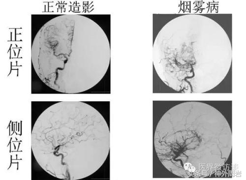 烟雾病脑内出血,烟雾病脑室出血死亡率