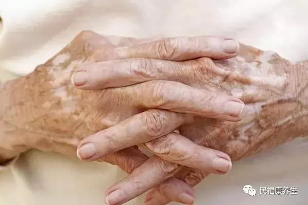 白癜风初期症状怎么辨别,白癜风早期自己怎样判断