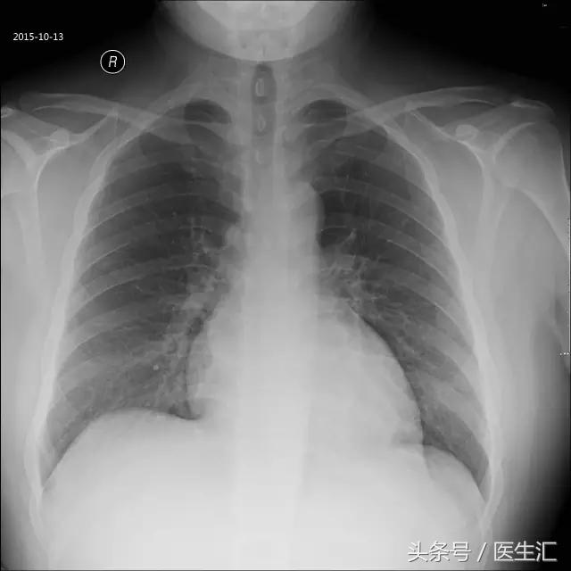 25岁能得心脏病吗,20岁就得了心衰