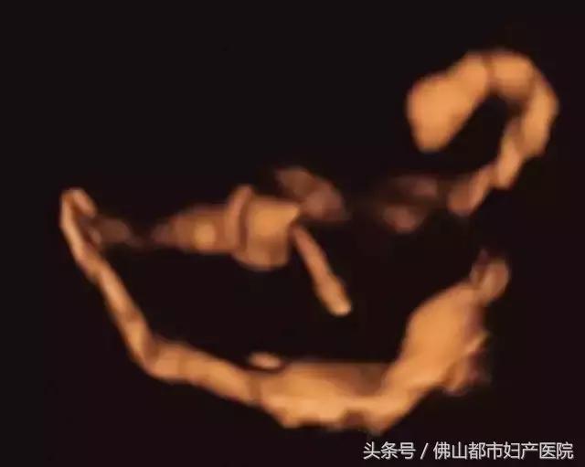 四维超声输卵管造影亲身经历,无痛四维输卵管造影