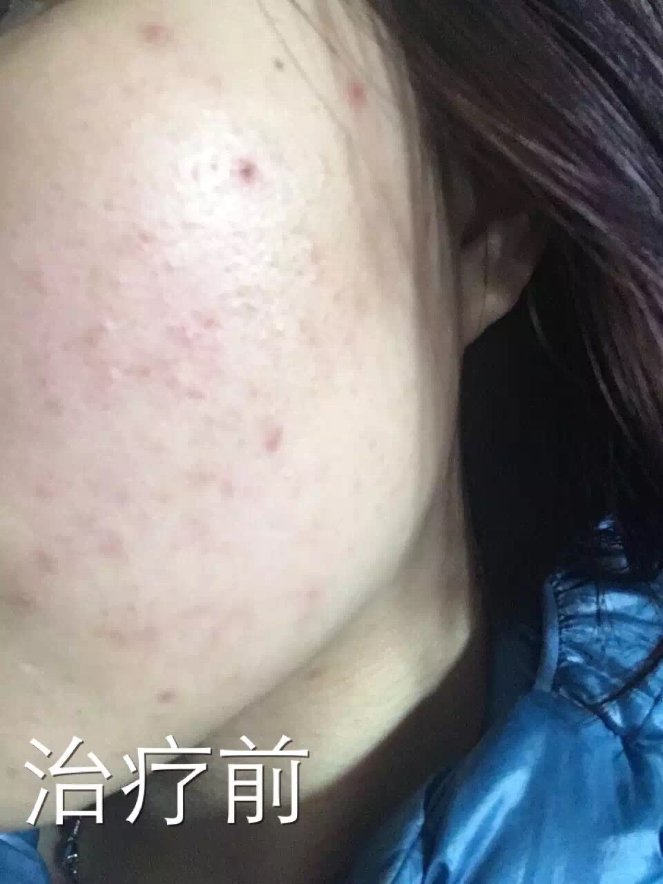 慎入！春季多发激素脸！你还要不要脸？