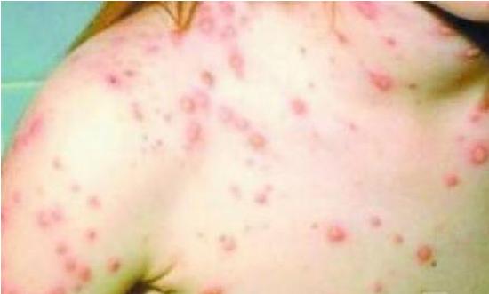 小孩得水痘了大人如何预防被传染,小孩疑似水痘怎么办