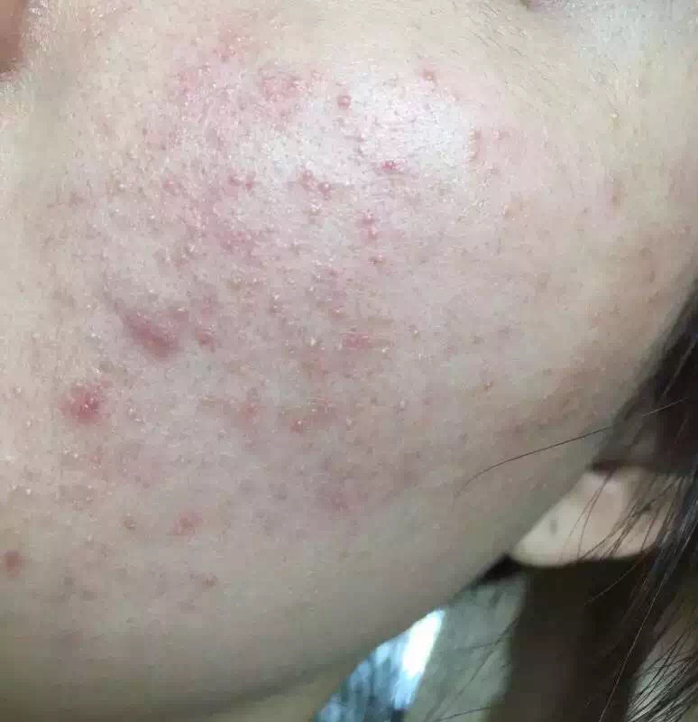 慎入！春季多发激素脸！你还要不要脸？