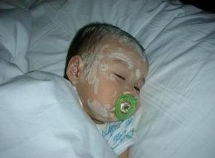 小孩得水痘了大人如何预防被传染,小孩疑似水痘怎么办