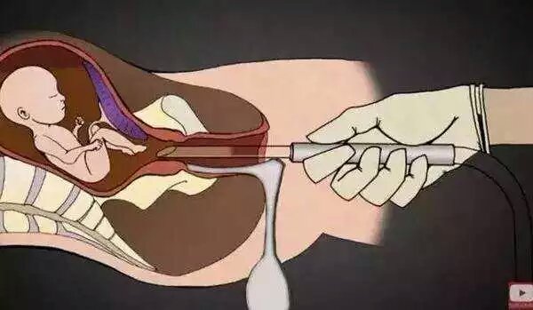 男的会接受女朋友打胎吗,你会建议你的女朋友打胎吗