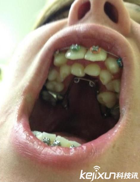 男孩嘴里有526颗牙,男孩多牙症300颗牙齿