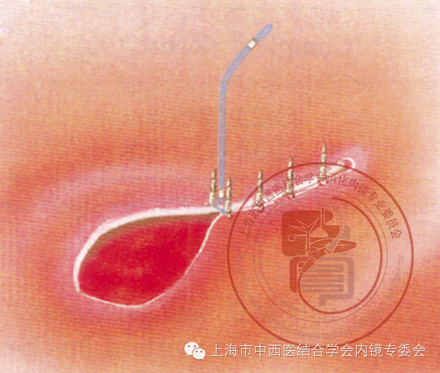 内镜套扎是什么,内镜套扎器械