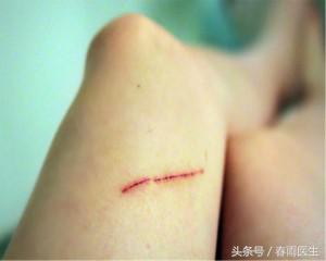 伤口包扎用什么包扎好得快,伤口包扎一般自己怎么处理