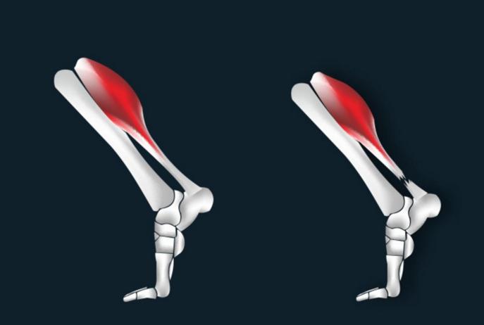 跑步时突然小腿与跟腱交界处痛,跑步跟腱疼痛如何快速恢复