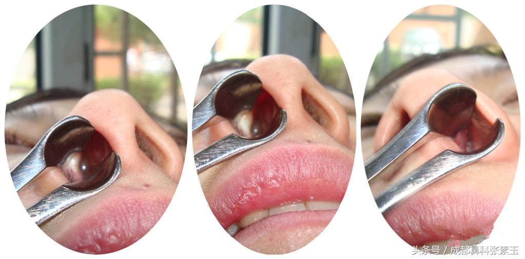 术后如何处理鼻息肉,鼻息肉术后注意事项如何防止复发