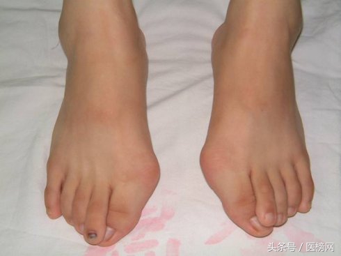 大连拇外翻治疗方法,拇外翻手术是微创吗有后遗症吗