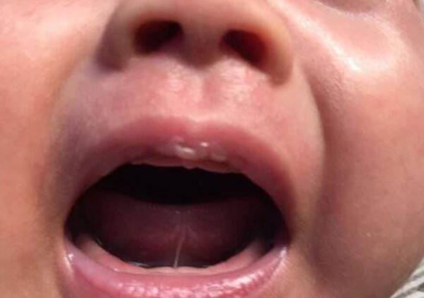 一岁多宝宝舌头w型正常吗,一岁半宝宝舌头伸出来竟是w型