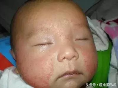 宝宝干性湿疹和奶粉有关吗,吃奶粉湿疹的症状