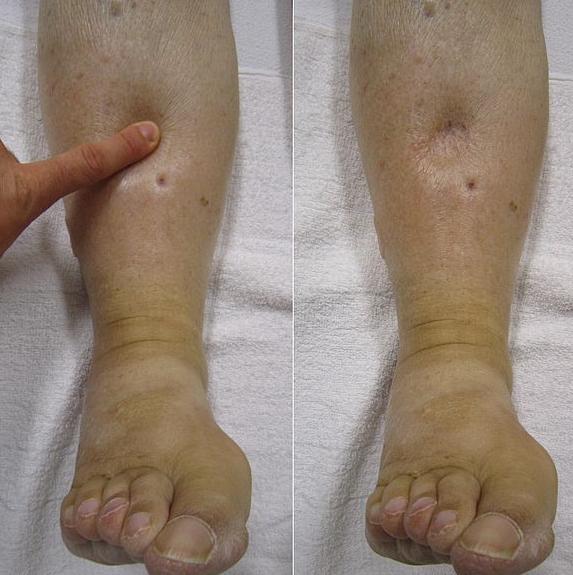 细胞回输能治愈慢性肾病吗,细胞回输可以彻底治愈肾炎吗