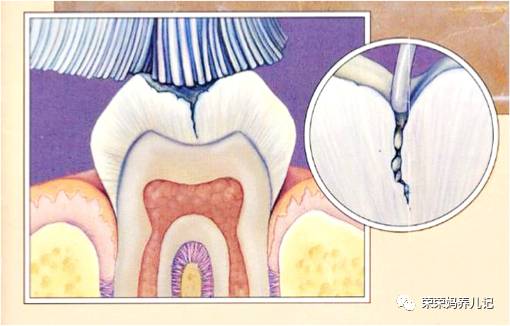 儿童涂氟前需要做口腔内窥镜吗,小孩牙齿涂氟好还是做窝沟封闭好