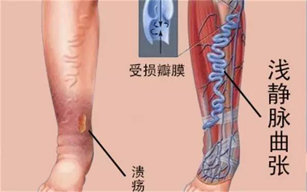 腿上长了这种包千万别瞎挤，小心猝死找上你！