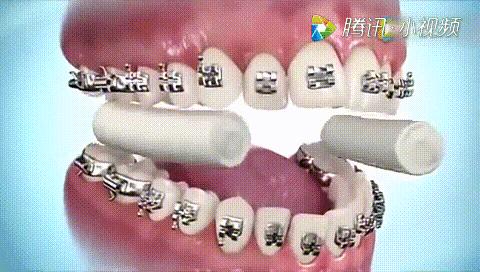 全瓷牙套怎么才算安装好,牙齿矫正有几种牙套图片