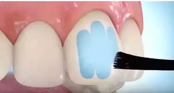 全瓷牙套怎么才算安装好,牙齿矫正有几种牙套图片