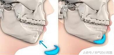 玻尿酸微整形丰下巴多少钱一针,下巴微整形要多少钱