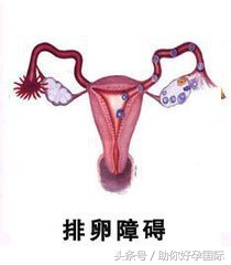 多囊排卵障碍怎么治疗,排卵功能障碍病因