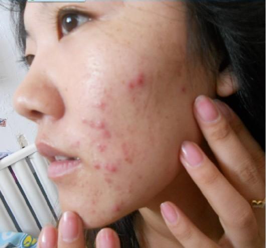 有痔疮这3个方法帮你改善,有痔疮怎么办才好得快