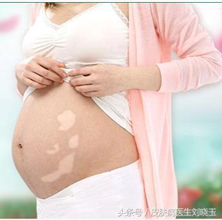 孕期的白癜风需要吃什么药,孕期白癜风患者要注意什么