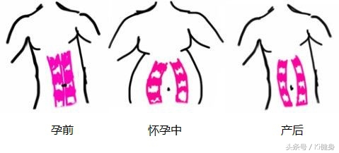 腹直肌分离检测及修复手法,腹直肌运动分析