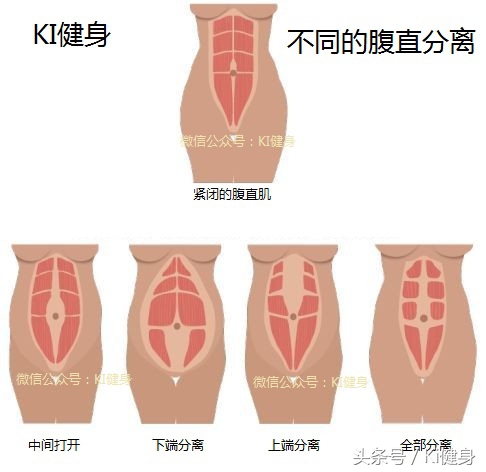 腹直肌分离要锻炼腹外斜肌吗,腹直肌运动解剖功能图