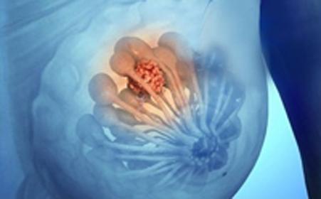 预防乳腺增生的健身操,吃什么能预防乳腺增生