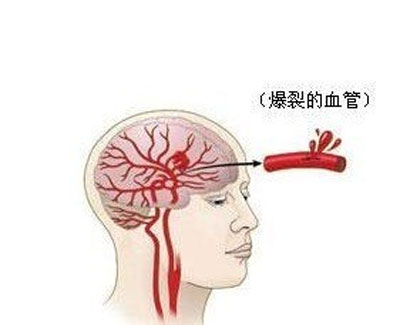 大脑供血不足头晕怎么治,脑供血不足最怕三种水果