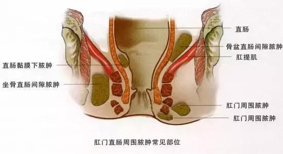 肛周脓肿硬块一般多长时间能消除,诱发肛周脓肿的原因都有哪些