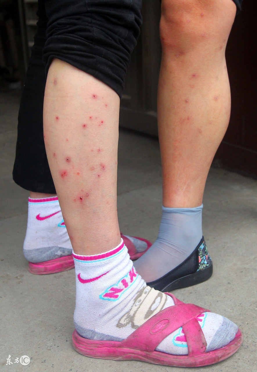 住校小学生身上起疙瘩是怎么回事,小学生突然浑身起红疙瘩