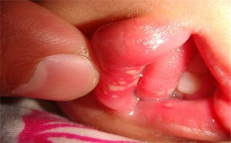 新生儿口腔溃疡怎么办有什么妙招,七岁宝宝口腔溃疡特别疼怎么办