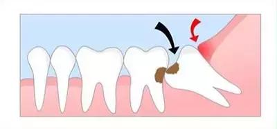 长智齿避免感染,长智齿如果不拔疼痛忍过去可以吗