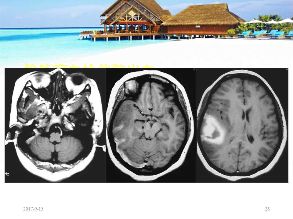 颅内静脉窦血栓形成怎么治疗,颅内静脉窦血栓形成最佳治疗方法