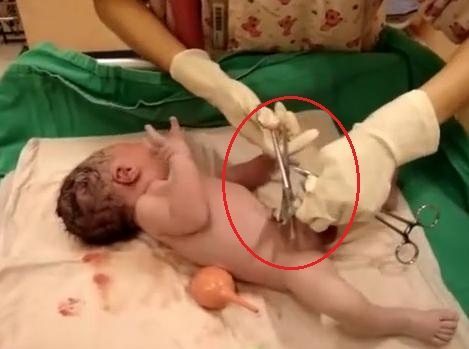 新生儿脐带被医生剪太长了怎么办,刚出生的婴儿被护士剪肚脐