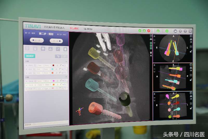 我国手术机器人,国内骨科手术机器人精准度