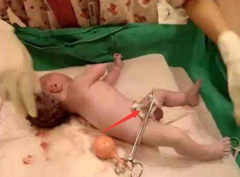 新生儿脐带被医生剪太长了怎么办,刚出生的婴儿被护士剪肚脐