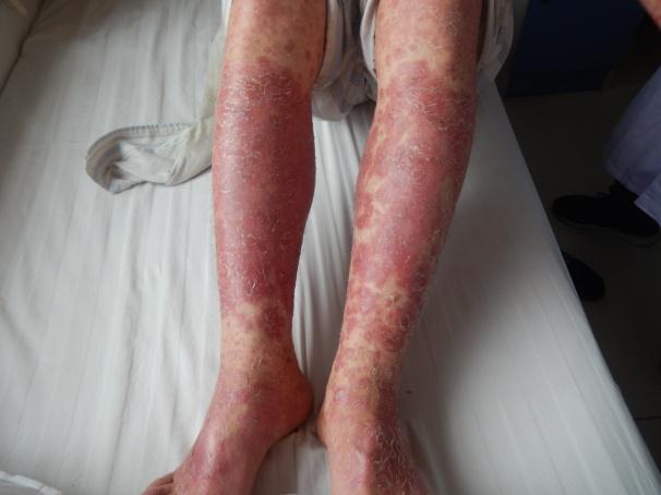 银屑病患者自述康复真实记录,银屑病患者自述真实经历