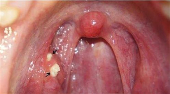 怎么可以彻底治愈扁桃体结石,扁桃体结石能否彻底治愈