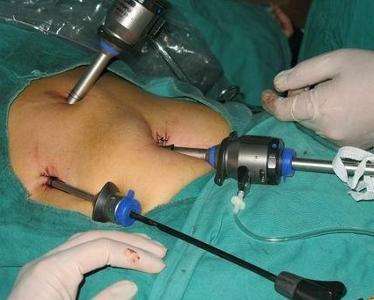 大的肾结石最好的治疗方法,肾结石体外震波碎石适合多大结石